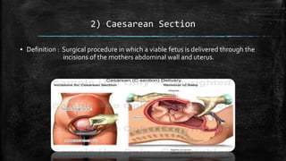 2) Caesarean Section
▪ Definition : Surgical procedure in which a viable fetus is delivered through the
incisions of the mothers abdominal wall and uterus.
 