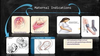 Maternal Indications
 