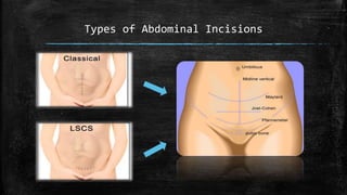 Types of Abdominal Incisions
 