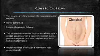 Classic Incision
▪ This involves a vertical incision into the upper uterine
segment.
▪ Rarely performed
▪ Incision allows rapid delivery.
▪ This incision is made when incision-to-delivery time is
critical, as well as when a transverse incision may not
provide adequate exposure or may be too prone to
hematoma formation.
▪ Higher incidence of infection & herniation. Poor
cosmetic result.
 