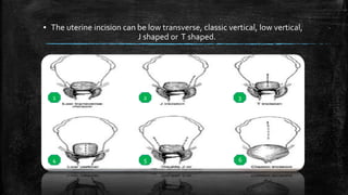 ▪ The uterine incision can be low transverse, classic vertical, low vertical,
J shaped or T shaped.
1 2 3
4 5 6
 