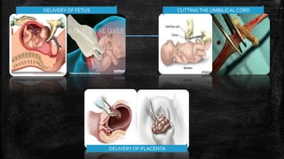 DELIVERYOF FETUS CUTTINGTHE UMBILICAL CORD
DELIVERYOF PLACENTA
 
