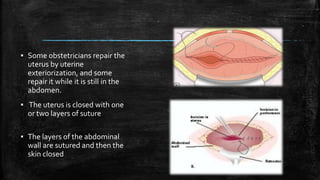 ▪ Some obstetricians repair the
uterus by uterine
exteriorization, and some
repair it while it is still in the
abdomen.
▪ The uterus is closed with one
or two layers of suture
▪ The layers of the abdominal
wall are sutured and then the
skin closed
 