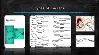 Types of Forceps
 