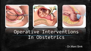 Operative Interventions
In Obstetrics
- Dr.Mani Smk
 