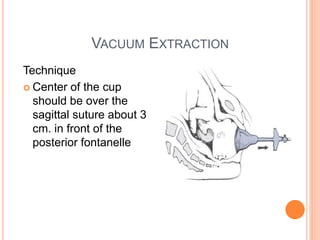 VACUUM EXTRACTION
Technique
 Center of the cup
should be over the
sagittal suture about 3
cm. in front of the
posterior fontanelle
 