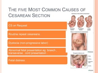 THE FIVE MOST COMMON CAUSES OF
CESAREAN SECTION
CS on Request
Routine repeat cesareans .
Dystocia (non-progressive labor) .
Abnormal fetal presentation eg breech ,
transeverse , cord presentation .
Fetal distress .
 