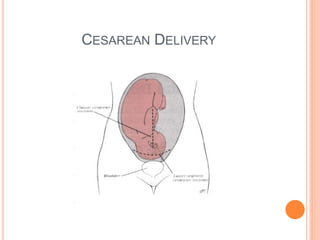 CESAREAN DELIVERY
 