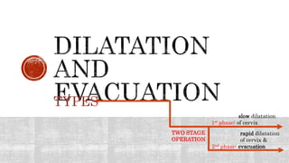 TYPES
TWO STAGE
OPERATION
rapid dilatation
of cervix &
2nd phase: evacuation
slow dilatation
1st phase: of cervix
 