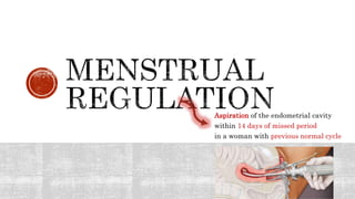Aspiration of the endometrial cavity
within 14 days of missed period
in a woman with previous normal cycle
 