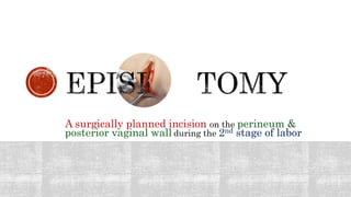 A surgically planned incision on the perineum &
posterior vaginal wall during the 2nd stage of labor
 