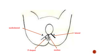 mediolateral
‘J’ shaped median
lateral
 