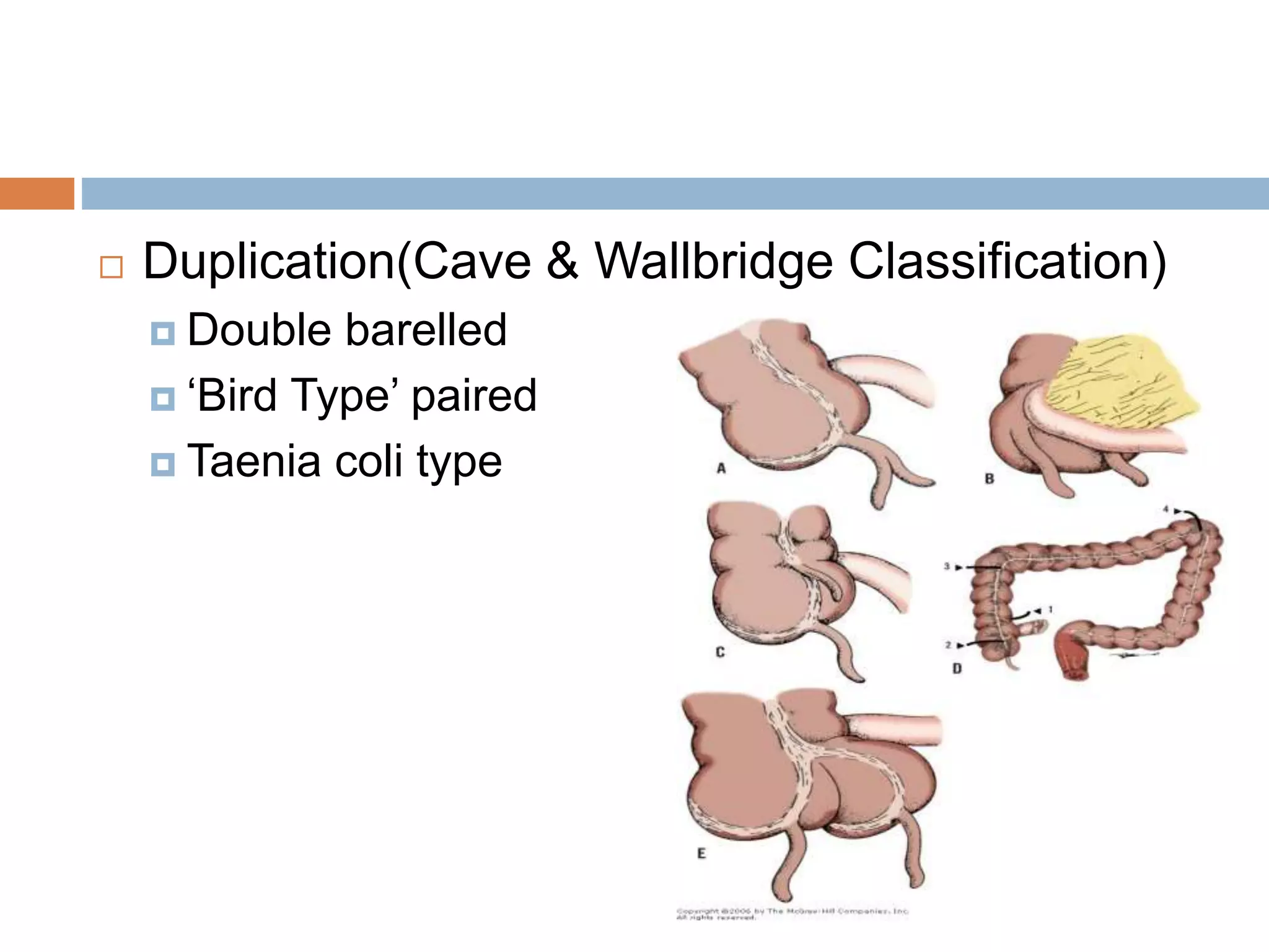  Duplication(Cave & Wallbridge Classification)
 Double barelled
 ‘Bird Type’ paired
 Taenia coli type
 