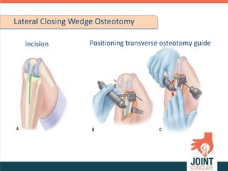 Osteo-arthritis Knee, strategies for management | PPTX