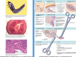 Operative surgery appendix | PPTX