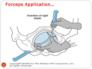 Using Forceps During Delivery Operative vaginal delivery | PPT