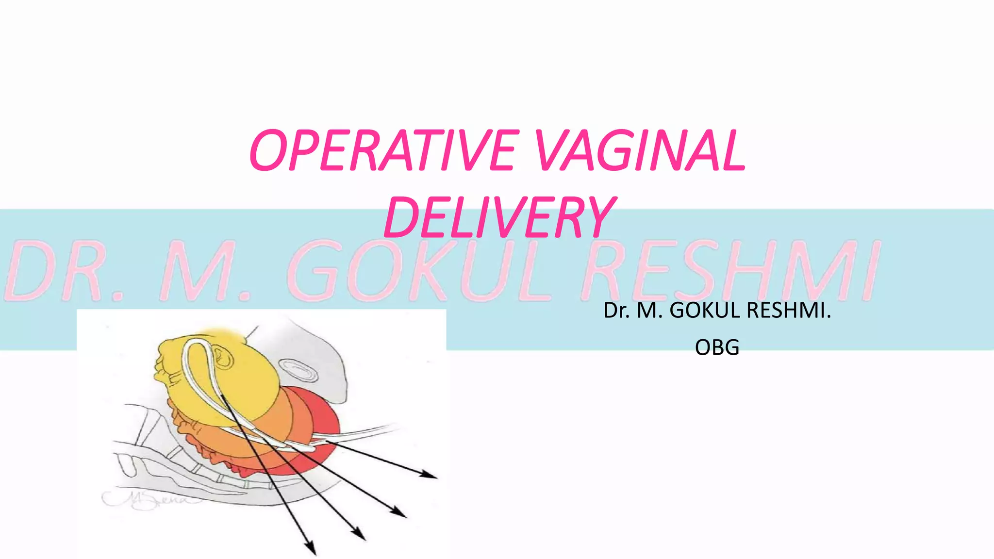 Operative vaginal delivery forceps , vacuum delivery. PPT