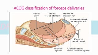 Operative vaginal delivery - forceps , vacuum delivery. | PPTX