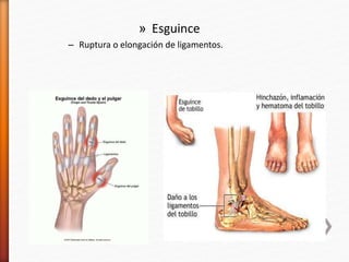 » Esguince
– Ruptura o elongación de ligamentos.
 
