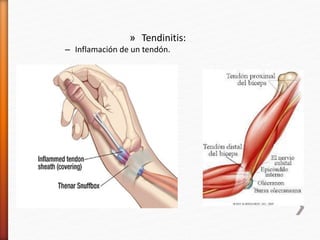 » Tendinitis:
– Inflamación de un tendón.
 