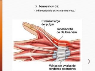 » Tenosinovitis:
– Inflamación de una vaina tendinosa.
 