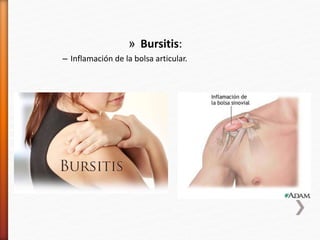 » Bursitis:
– Inflamación de la bolsa articular.
 