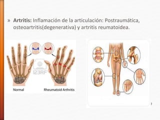 » Artritis: Inflamación de la articulación: Postraumática,
osteoartritis(degenerativa) y artritis reumatoidea.
 