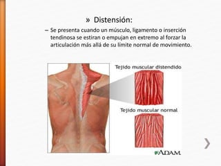 » Distensión:
– Se presenta cuando un músculo, ligamento o inserción
tendinosa se estiran o empujan en extremo al forzar la
articulación más allá de su límite normal de movimiento.
 