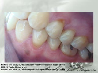 Martinez Ross Erik et, al, “Rehabilitacion y recontruccionoclusal” Tercera Edicion 2006, ED, Cuellar, Mexico  p  145Martinez Ross Erik Et, Al, OclusionOrganica y  Ortognatodoncia,  2009, p 372-373