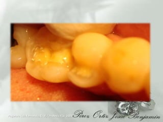 PegoraroLuiz Fernando, Et al, “Protesis Fija  2001”