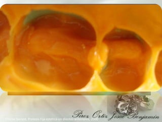 Chiche Gerard, Protesis Fija estética en dientes anteriores, 2000