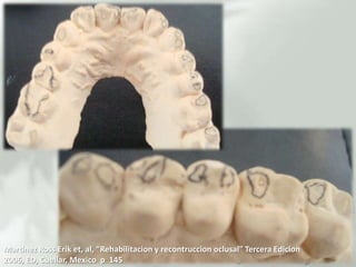 Martinez Ross Erik et, al, “Rehabilitacion y recontruccionoclusal” Tercera Edicion 2006, ED, Cuellar, Mexico  p  145