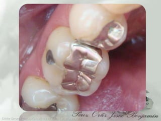 Chiche Gerard, Protesis Fija estética en dientes anteriores, 2000