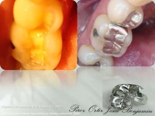 PegoraroLuiz Fernando, Et al, Protesis Fija  2001Chiche Gerard, Protesis Fija estética en dientes anteriores, 2000