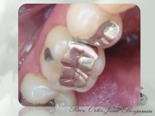 Incrustaciones Caso clinico , Josue Benjamin Perez Ortiz