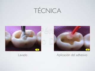Nicolás Pérez Quiroz
Cirujano Dentista
TÉCNICA
Sistema adhesivo
Lavado Aplicación del adhesivo
 