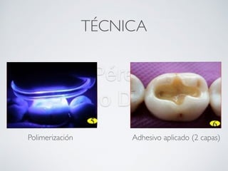 Nicolás Pérez Quiroz
Cirujano Dentista
TÉCNICA
Sistema adhesivo
Polimerización Adhesivo aplicado (2 capas)
 
