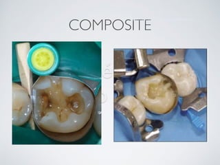 Nicolás Pérez Quiroz
Cirujano Dentista
COMPOSITE
Sistema matriz dientes posteriores
 