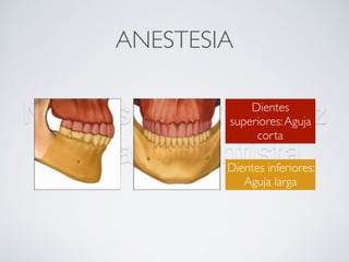 Nicolás Pérez Quiroz
Cirujano Dentista
ANESTESIA
Dientes inferiores:
Aguja larga
Dientes
superiores:Aguja
corta
 