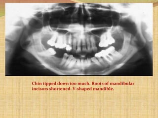 Chin tipped down too much. Roots of mandibular
incisors shortened. V-shaped mandible.
 