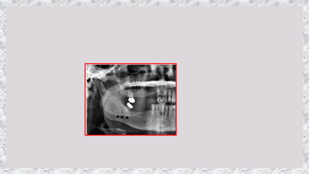OPG (ORTHOPANTOMOGRAPHY) - PANORAMIC RADIOGRAPHY- DR PRIYANKA | PPTX
