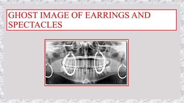 OPG (ORTHOPANTOMOGRAPHY) - PANORAMIC RADIOGRAPHY- DR PRIYANKA | PPTX