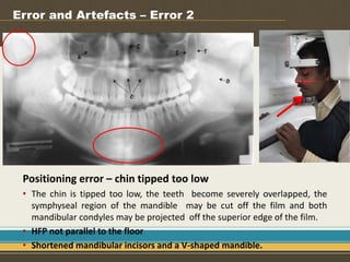 Opg and lateral cephalometric | PPT