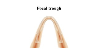 Focal trough
 