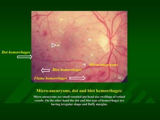 dot blot hemorrhage vs microaneurysm dot blot hemorrhage vs microaneurysm