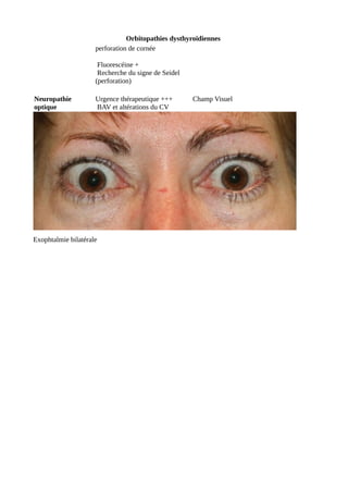 Orbitopathies dysthyroïdiennes
perforation de cornée
Fluorescéine +
Recherche du signe de Seidel
(perforation)
Neuropathie
optique
Urgence thérapeutique +++
BAV et altérations du CV
Champ Visuel
Exophtalmie bilatérale
 