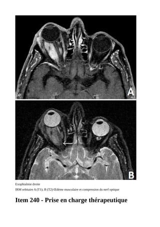 Exophtalmie droite
IRM orbitaire A (T1); B (T2) Œdème musculaire et compression du nerf optique
Item 240 - Prise en charge thérapeutique
 