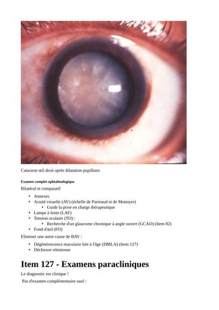 Cataracte œil droit après dilatation pupillaire
Examen complet ophtalmologique
Bilatéral et comparatif
• Annexes
• Acuité visuelle (AV) (échelle de Parinaud et de Monoyer)
• Guide la prise en charge thérapeutique
• Lampe à fente (LAF)
• Tension oculaire (TO) :
• Recherche d'un glaucome chronique à angle ouvert (GCAO) (Item 82)
• Fond d'œil (FO)
Eliminer une autre cause de BAV :
• Dégénérescence maculaire liée à l'âge (DMLA) (Item 127)
• Déchirure rétinienne
Item 127 - Examens paracliniques
Le diagnostic est clinique !
Pas d'examen complémentaire sauf :
 