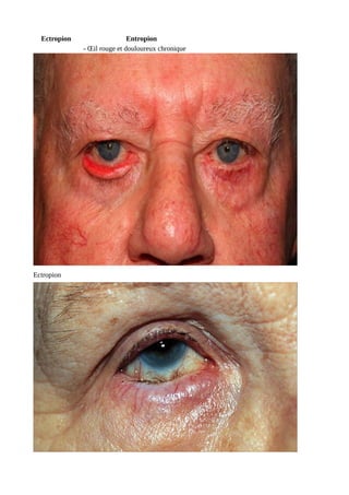 Ectropion Entropion
- Œil rouge et douloureux chronique
Ectropion
 