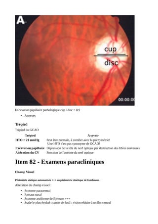 Excavation papillaire pathologique cup / disc = 0,9
• Annexes
Trépied
Trépied du GCAO
Trépied A savoir
HTO > 21 mmHg Peut être normale, à corréler avec la pachymétrie!
Une HTO n'est pas synonyme de GCAO!
Excavation papillaire Dépression de la tête du nerf optique par destruction des fibres nerveuses
Altération du CV Fonction de l'atteinte du nerf optique
Item 82 - Examens paracliniques
Champ Visuel
Périmétrie statique automatisée +++ ou périmétrie cinétique de Goldmann
Altération du champ visuel :
• Scotome paracentral
• Ressaut nasal
• Scotome arciforme de Bjerrum +++
• Stade le plus évolué : canon de fusil : vision réduite à un îlot central
 